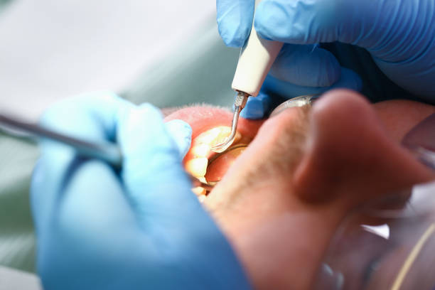 Best Emergency Dentist for Lost Fillings or Crowns in Maggie Valley, NC
